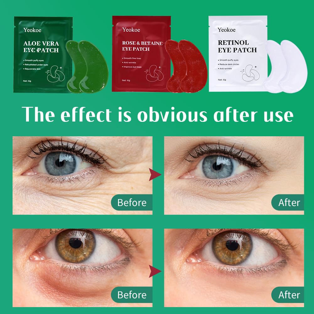 Yeokoe Under Eye Patches for Dark Circles,Eye Mask for Puffy Eyes With Collagen,Retinol,Vitmin C,Hyaluronic Acid and Niacinamide Face Masks Skincare Spa Gifts for Woman 20Pairs